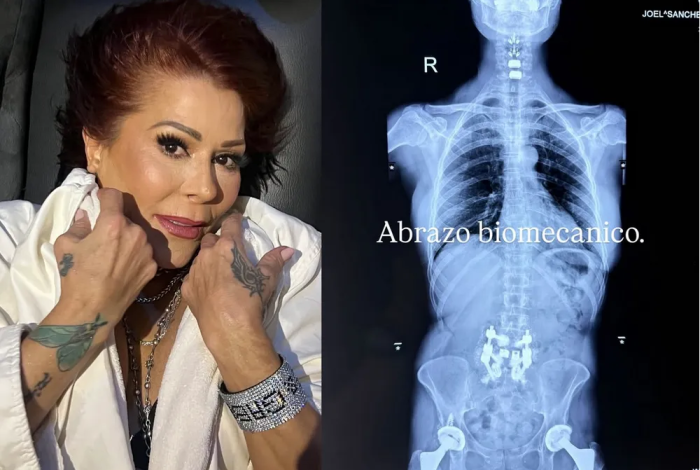 Alejandra Guzmán revela su “abrazo biomecánico” tras cirugía