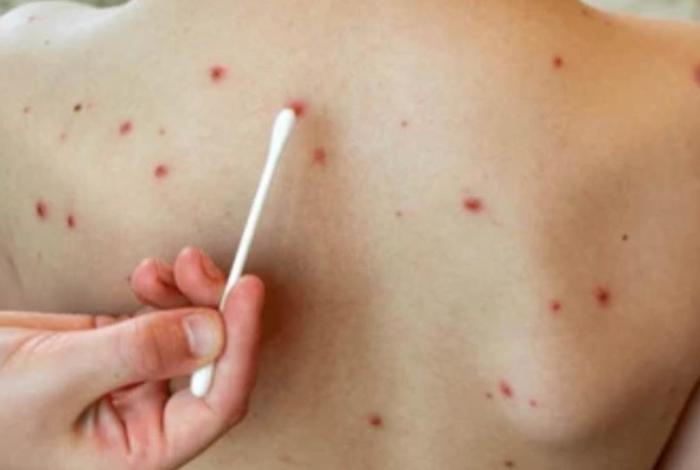 Bajo control, casos de sarampión en Maravatío 