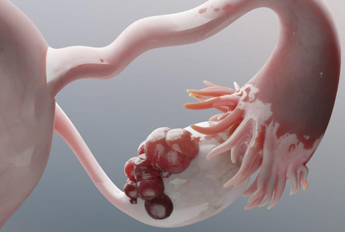 Cáncer de ovario cobra más de 3 mil vidas al año en México; urgen atención prioritaria