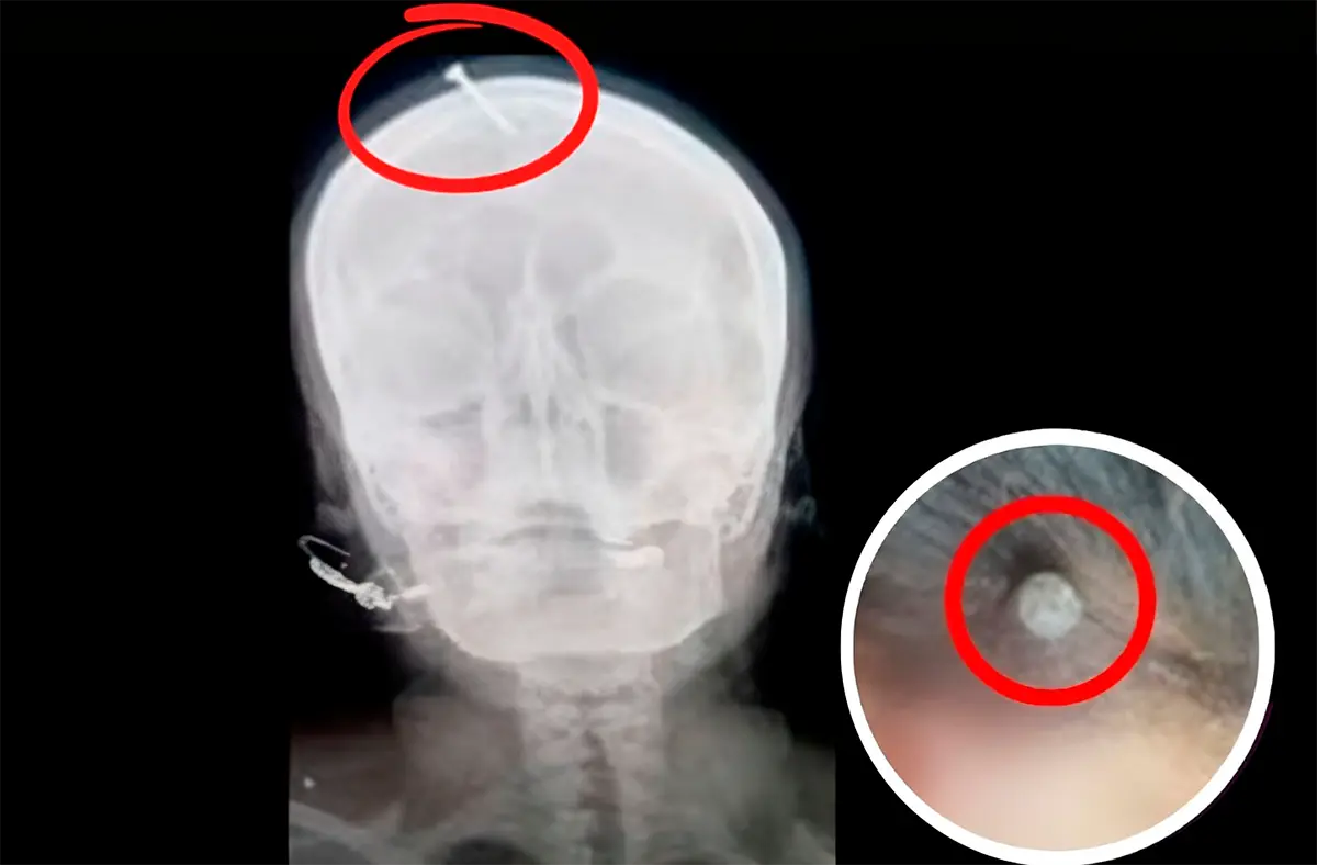 Clavos en la cabeza por un hijo varón: el alto precio de nacer mujer