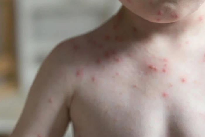 Con dos decesos en Michoacán y Tlaxcala, suman 28 muertes por sarampión en México