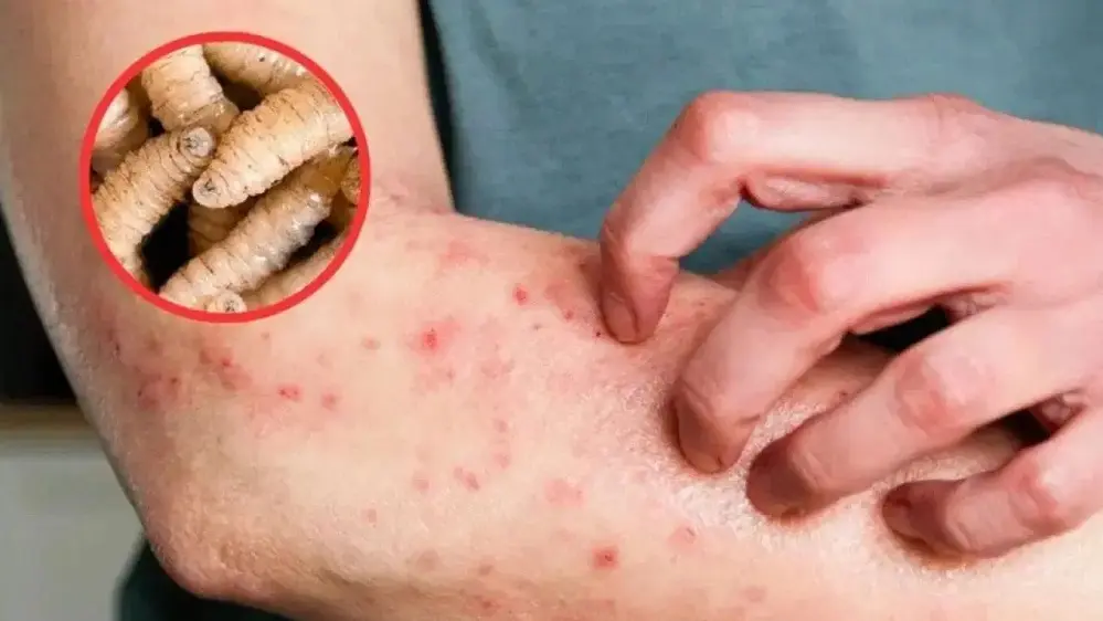 Confirman cinco nuevos casos de infección en humanos por gusano barrenador