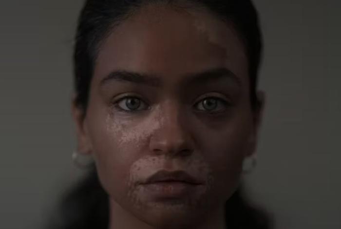 Día Mundial del Vitiligo