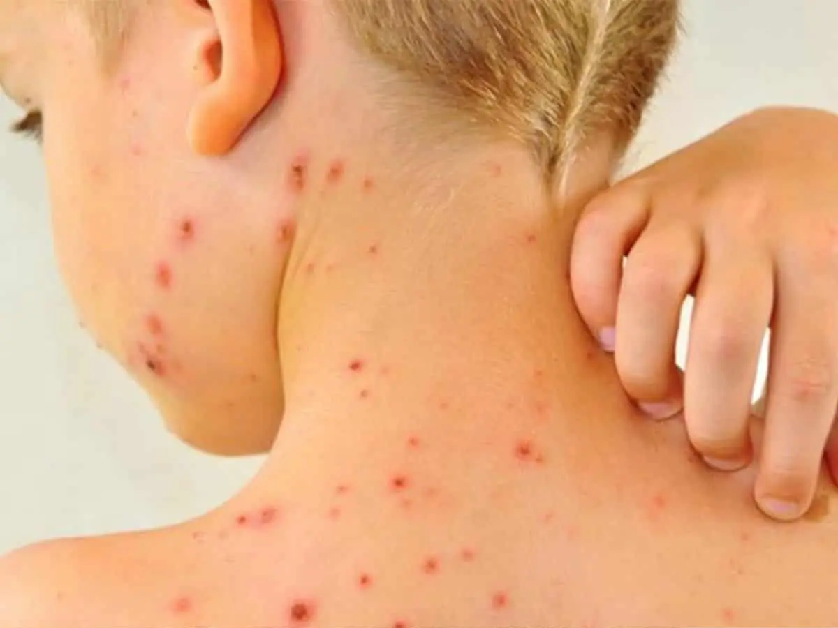 En lo que va de 2025 se han reportado alrededor de 58 casos de sarampión