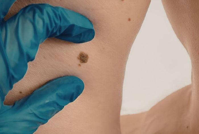 México registra 2,198 casos de melanoma al año; 80 % llega tarde al diagnóstico